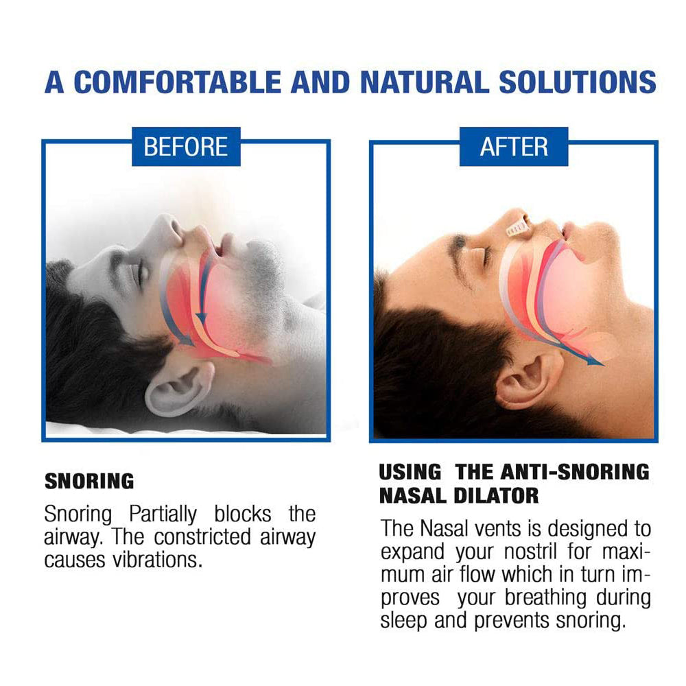Anti-Snoring Nose Vent – Snore Stopper for Better Sleep